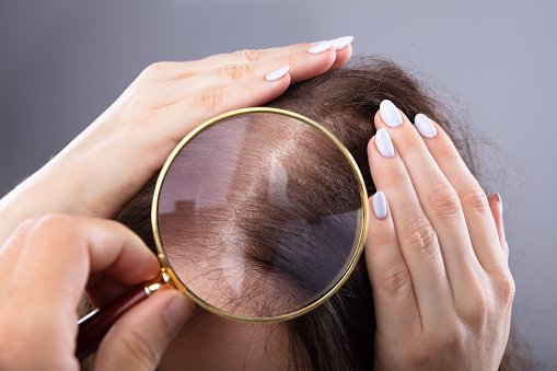 Hair loss due to hair wax