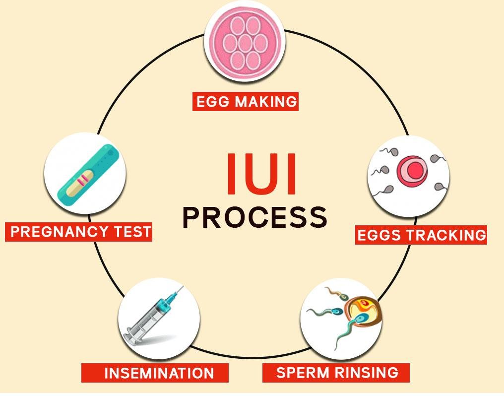 How Many IUI Treatment Cycles Do You Need for Successful Conception?