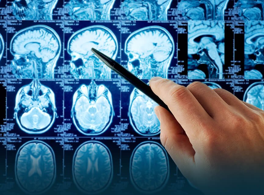 Best Hospital For Epilepsy Surgery In India